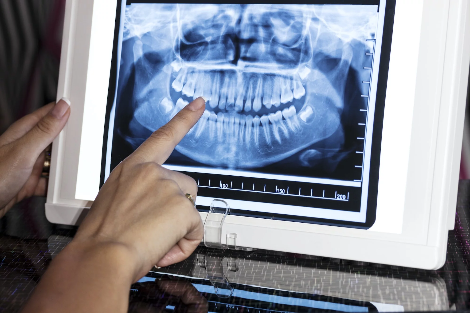 dental panoramic x ray