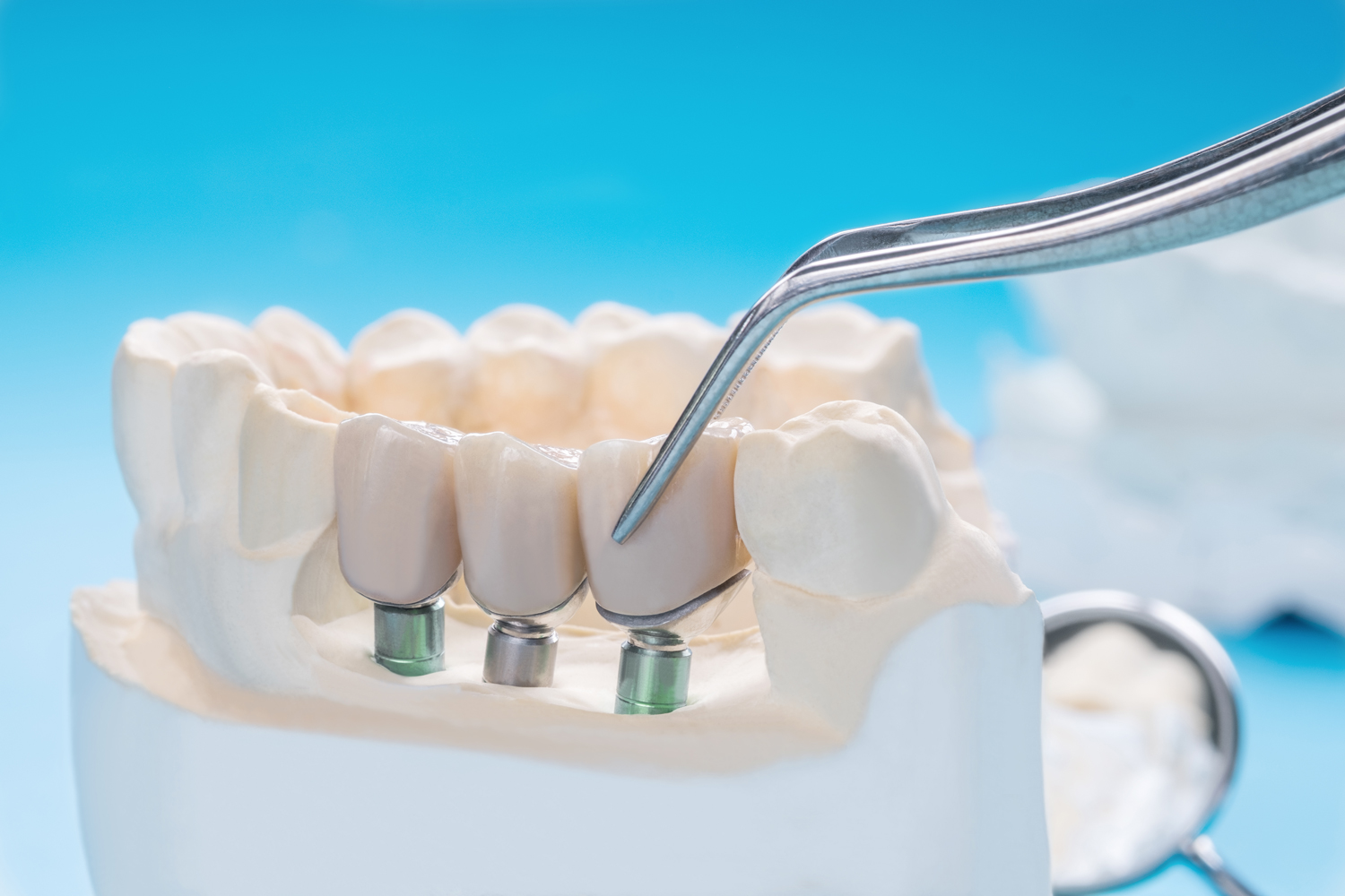 close-up-implan-model-tooth-support-fix-bridge-implan-crown